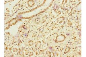 Immunohistochemistry of paraffin-embedded human pancreatic cancer using ABIN7167094 at dilution of 1:100 (RanBP3 antibody  (AA 1-250))