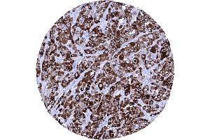 Strong cytoplasmic PMEL immunostaining in all cells of a malignant melanoma of the skin (Recombinant Melanoma gp100 antibody)