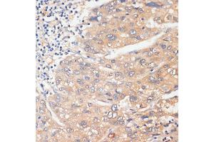 Immunohistochemistry of paraffin-embedded human liver cancer using WNK3 antibody (ABIN6132518, ABIN6150236, ABIN6150237 and ABIN6221221) at dilution of 1:100 (40x lens). (WNK3 antibody)
