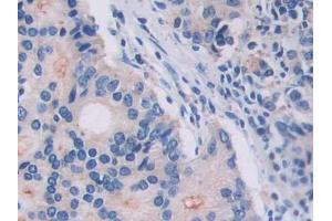 IHC-P analysis of Human Prostate cancer Tissue, with DAB staining. (IL18R1 antibody  (AA 147-255))