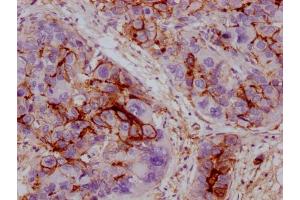 IHC image of ABIN7180754 diluted at 1:100 and staining in paraffin-embedded human liver cancer performed on a Leica BondTM system. (ICAM1 antibody)