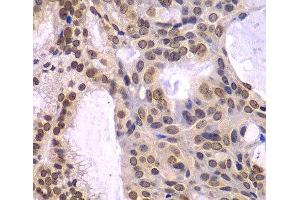 Immunohistochemistry of paraffin-embedded Human oophoroma using POLD3 Polyclonal Antibody at dilution of 1:100 (40x lens). (POLD3 antibody)