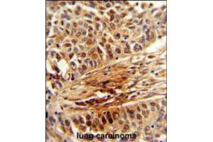 Formalin-fixed and paraffin-embedded human lung carcinoma reacted with PIN1 Antibody , which was peroxidase-conjugated to the secondary antibody, followed by DAB staining. (PIN1 antibody  (AA 30-56))