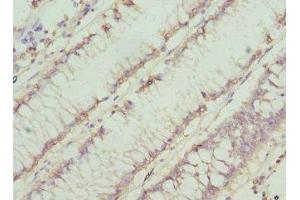 Immunohistochemistry of paraffin-embedded human colon cancer using ABIN7160753 at dilution of 1:100 (CHN1 antibody  (AA 1-200))