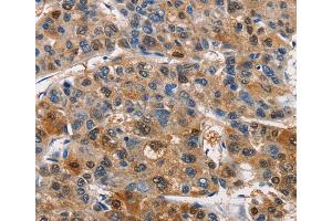 Immunohistochemistry (IHC) image for anti-Pim-1 Oncogene (PIM1) antibody (ABIN2422821) (PIM1 antibody)