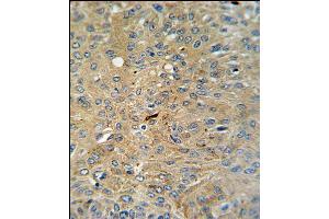 Cleaved-CASP3 (Asp175)Antibody (ABIN650861 and ABIN2839812) IHC analysis in formalin fixed and paraffin embedded human lung carcinoma followed by peroxidase conjugation of the secondary antibody and DAB staining. (Caspase 3 antibody  (Cleaved-Asp175))