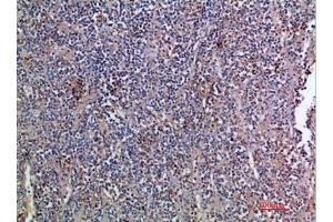 Immunohistochemical analysis of paraffin-embedded human-kidney-cancer, antibody was diluted at 1:200. (EGF antibody  (AA 1000-1060))