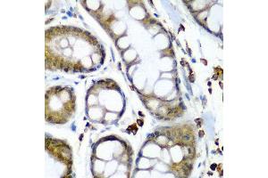 Immunohistochemistry of paraffin-embedded human colon carcinoma using SECISBP2 antibody at dilution of 1:200 (40x lens). (SECISBP2 antibody)