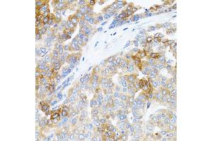 Immunohistochemistry of paraffin-embedded human liver cancer using STAT3 antibody (ABIN1876697) at dilution of 1:100 (40x lens). (STAT3 antibody)