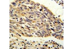 PKM2 antibody IHC analysis in formalin fixed and paraffin embedded human lung carcinoma. (PKM2 antibody  (AA 116-145))