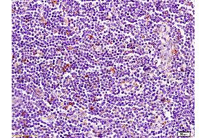 Formalin-fixed and paraffin embedded human pancreatic cancer tissue labeled with Anti-CD1A Polyclonal Antibody, Unconjugated (ABIN702700) at 1:200 followed by conjugation to the secondary antibody and DAB staining (CD1d1 antibody  (AA 51-150))