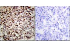 Immunohistochemistry analysis of paraffin-embedded human breast carcinoma tissue, using Histone H2B (Acetyl-Lys15) Antibody. (Histone H2B antibody  (acLys15))