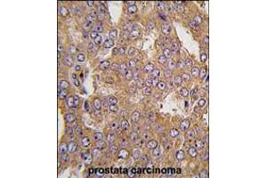 Formalin-fixed and paraffin-embedded human prostata carcinoma tissue reacted with NARS2 antibody , which was peroxidase-conjugated to the secondary antibody, followed by DAB staining. (NARS2 antibody  (C-Term))