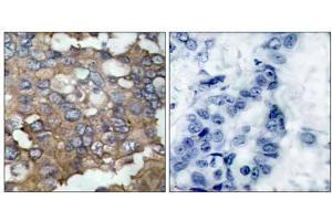 Immunohistochemical analysis of paraffin-embedded human breast carcinoma tissue using Src (Ab-529) antibody (E021168). (Src antibody)