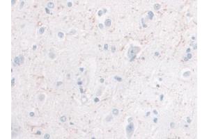 IHC-P analysis of Human Glioma Tissue, with DAB staining. (IL-10 antibody  (AA 1-178))