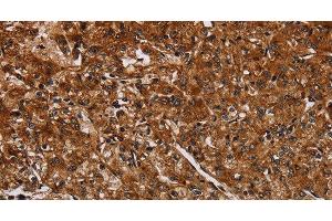 Immunohistochemistry of paraffin-embedded Human prostate cancer using ACP6 Polyclonal Antibody at dilution of 1:30 (ACP6 antibody)