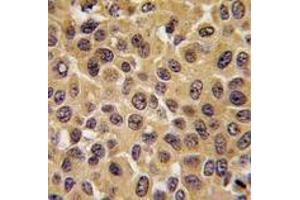 Formalin-fixed and paraffin-embedded human hepatocarcinoma tissue reacted with CDC25B antibody (Center), which was peroxidase-conjugated to the secondary antibody, followed by DAB staining. (CDC25B antibody  (Center))