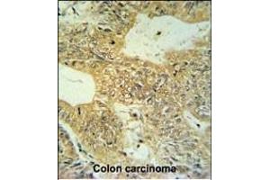 CLDN23 Antibody (C-term) (ABIN653789 and ABIN2843074) IHC analysis in formalin fixed and paraffin embedded colon carcinoma followed by peroxidase conjugation of the secondary antibody and DAB staining. (Claudin 23 antibody  (C-Term))