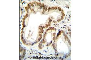 BTG2 Antibody immunohistochemistry analysis in formalin fixed and paraffin embedded human prostate carcinoma followed by peroxidase conjugation of the secondary antibody and DAB staining. (BTG2 antibody  (N-Term))