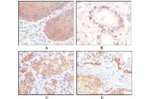 Immunohistochemical analysis of paraffin-embedded human esophagus epithelium (A), salivary gland basal cell (B), lung squamous cell carcinoma (C), endometrium admosquamous carcinoma (D), showing cytoplasmic and membrane localization using CK5 antibody with DAB staining. (Cytokeratin 5 antibody)