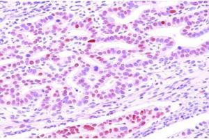 Paraffin embedded sections of human gastric canitrocelluloseer tissue were initrocelluloseubated with anti-human DACT3 (1:50) for 2 hours at room temperature. (DACT3 antibody  (AA 89-202))