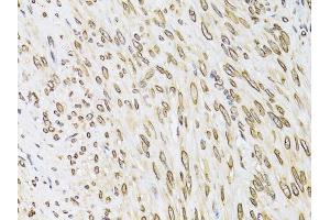 Immunohistochemistry of paraffin-embedded human uterine cancer using EMD antibody. (Emerin antibody)