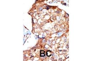 Formalin-fixed and paraffin-embedded human cancer tissue reacted with the primary antibody, which was peroxidase-conjugated to the secondary antibody, followed by DAB staining. (ZAP70 antibody  (AA 252-282))