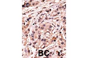 Formalin-fixed and paraffin-embedded human cancer tissue reacted with the primary antibody, which was peroxidase-conjugated to the secondary antibody, followed by AEC staining. (p53 antibody  (pSer20))