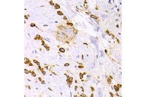 Immunohistochemistry of paraffin-embedded human gastric cancer using KRT15 antibody. (KRT15 antibody)