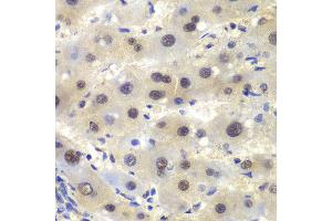 Immunohistochemistry of paraffin-embedded human liver cancer using CSNK2A2 antibody at dilution of 1:100 (400x lens). (CSNK2A2 antibody)