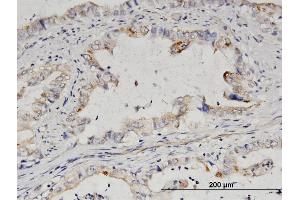 Immunoperoxidase of purified MaxPab antibody to NUP50 on formalin-fixed paraffin-embedded human pancreatic cancer. (NUP50 antibody  (AA 1-468))