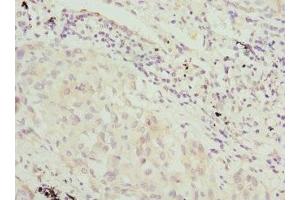 Immunohistochemistry of paraffin-embedded human lung cancer using ABIN7169217 at dilution of 1:100 (VRK1 antibody  (AA 257-396))