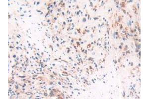 IHC-P analysis of Human Prostate Gland Cancer Tissue, with DAB staining. (IFI30 antibody  (AA 1-250))