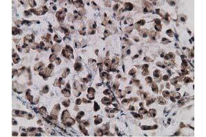 Immunohistochemical staining of paraffin-embedded Adenocarcinoma of Human colon tissue using anti-GPHN mouse monoclonal antibody. (Gephyrin antibody)