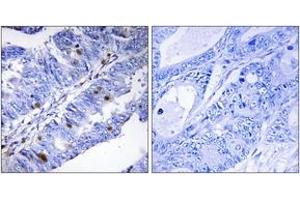 Immunohistochemistry analysis of paraffin-embedded human colon carcinoma, using Nuclear Receptor NR4A1 (Phospho-Ser351) Antibody. (NR4A1 antibody  (pSer351))