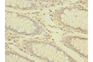Immunohistochemistry of paraffin-embedded human colon cancer using ABIN7172869 at dilution of 1:100 (TRPM7 antibody  (AA 756-855))