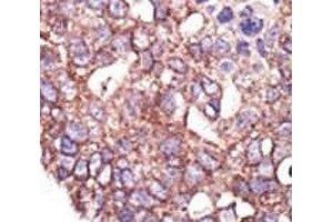 IHC analysis of FFPE human breast carcinoma tissue stained with the SYVN1 antibody (SYVN1 antibody  (AA 586-617))