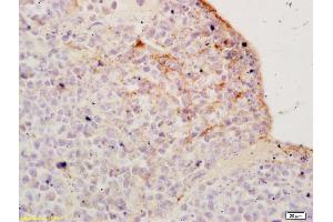 Formalin-fixed and paraffin embedded mouse colon carcinoma labeled with Rabbit Anti PI 3 Kinase p85 beta Polyclonal Antibody, Unconjugated (ABIN754723) at 1:200 followed by conjugation to the secondary antibody and DAB staining (PIK3R2 antibody)