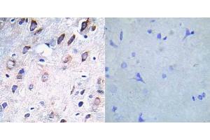 Immunohistochemical analysis of paraffin-embedded human breast carcinoma tissue using PDGFR beta (phospho-Tyr751) antibody (E012033). (PDGFRB antibody  (pTyr751))