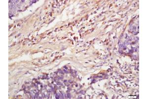 Formalin-fixed and paraffin embedded human lung carcinoma labeled with Anti-Phospho-MAPKAPK2(Ser272)Polyclonal Antibody, Unconjugated (ABIN710531) at 1:200, followed by conjugation to the secondary antibody and DAB staining (MAPKAP Kinase 2 antibody  (pSer272))