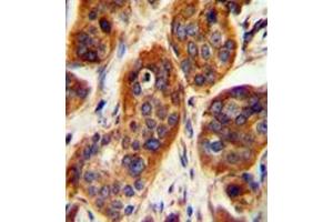 Immunohistochemistry analysis in formalin fixed and paraffin embedded human bladder carcinoma reacted with LRRC57 Antibody (C-term) followed which was peroxidase conjugated to the secondary antibody and followed by DAB staining. (LRRC57 antibody  (C-Term))