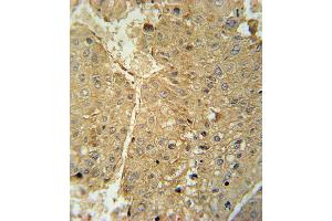 ADH1C Antibody immunohistochemistry analysis in formalin fixed and paraffin embedded human hepatocarcinoma followed by peroxidase conjugation of the secondary antibody and DAB staining. (ADH1C antibody  (AA 231-260))