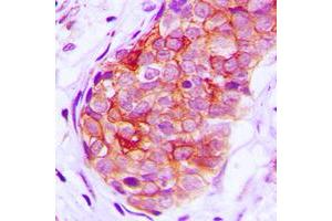 Immunohistochemical analysis of GRK6 staining in human breast cancer formalin fixed paraffin embedded tissue section. (GRK6 antibody  (N-Term))