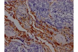 IHC image of ABIN7127559 diluted at 1:100 and staining in paraffin-embedded human lung cancer performed on a Leica BondTM system. (Recombinant ICAM1 antibody)