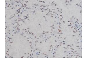 ABIN6267323 at 1/200 staining Human lung cancer tissue sections by IHC-P. (NPM1 antibody  (pThr199))
