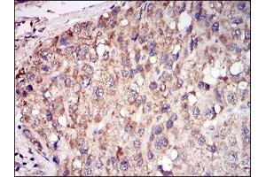 Immunohistochemical analysis of paraffin-embedded liver cancer tissues using ACP5 mouse mAb with DAB staining. (ACP5 antibody  (AA 221-325))