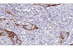 ABIN6273628 at 1/100 staining Human urothelial cancer tissue by IHC-P. (FGFBP1 antibody  (C-Term))