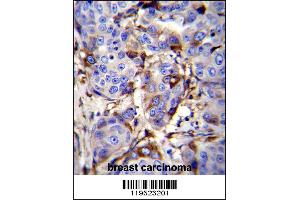 GCDFP-15 Antibody immunohistochemistry analysis in formalin fixed and paraffin embedded human breast carcinoma followed by peroxidase conjugation of the secondary antibody and DAB staining. (PIP antibody  (C-Term))