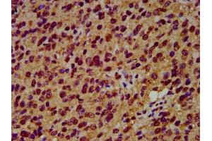 IHC image of ABIN7151218 diluted at 1:600 and staining in paraffin-embedded human glioma performed on a Leica BondTM system. (SIAH2 antibody  (AA 1-72))