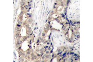 Immunohistochemistry of paraffin-embedded human breast carcinoma using Phospho-ABL1-Y412 antibody (ABIN2987872). (ABL1 antibody  (pTyr412))